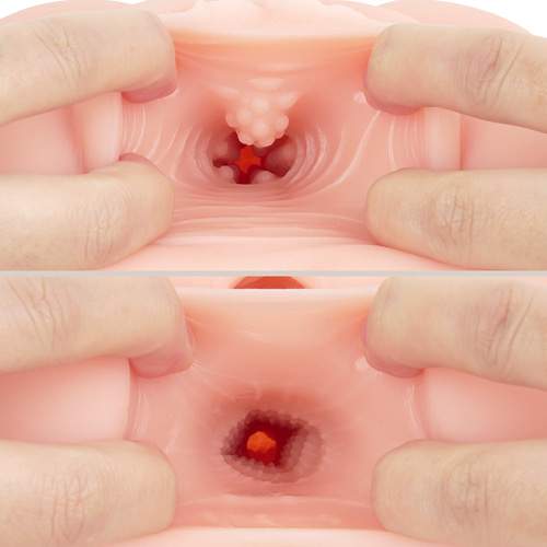 극상 질육 생음순